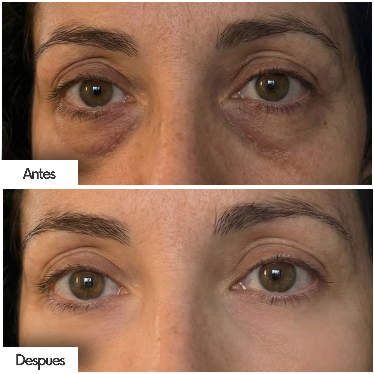 Sérum Antiojeras y Bolsas – Ácido Hialurónico + Niacinamida