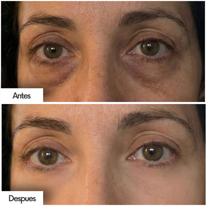 Sérum Antiojeras y Bolsas – Ácido Hialurónico + Niacinamida