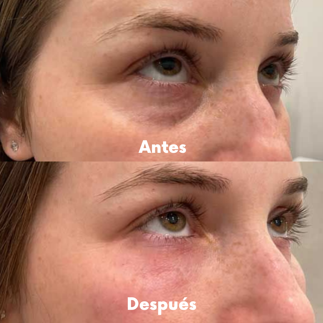 Gafas Redermis: Eliminá las ojeras y bolsas en 7 días