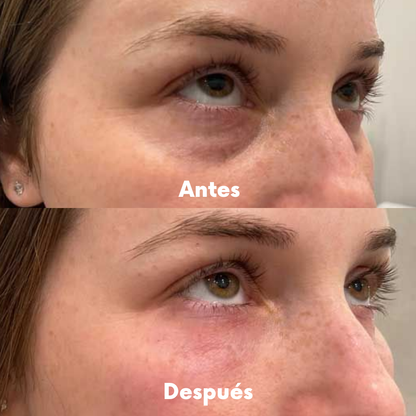 Gafas Redermis: Eliminá las ojeras y bolsas en 7 días
